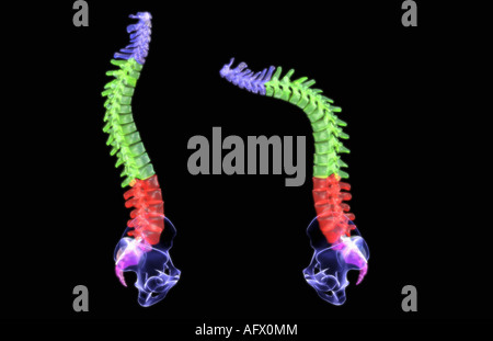 Spondylitis Stockfoto