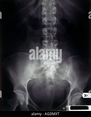 Röntgen der menschlichen Wirbelsäule & Hüften Stockfoto