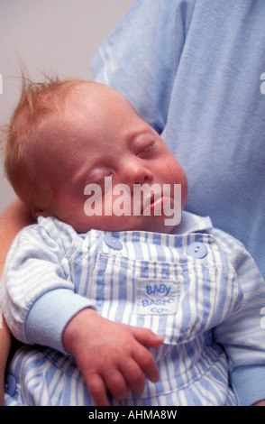 neugeborenes Baby mit Down-Syndrom-Krankheit Stockfoto
