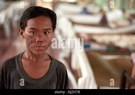 Asien Philippinen Panay Insel Santa Barbara Young Boy mit Gesicht Narben vom Aussatz an Western Visayas Sanatorium Stockfoto