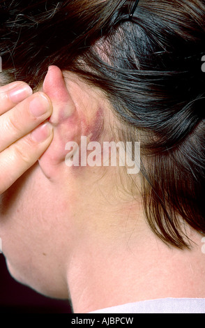 Foto zeigt Schlachten unterzeichnen auch mastoid Ekchymosen, ein Hinweis auf Bruch der Basis des hinteren Teil des Schädels Stockfoto