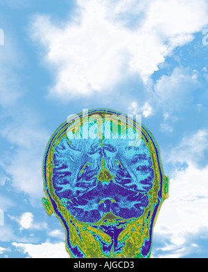 Magnetic Resonance Imaging (MRI) der einen Schnitt durch einen menschlichen Kopf, Rückansicht zeigt das Gehirn. Himmelshintergrund. Stockfoto