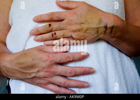 Verletzungen an Hand und Arm einer Frau Stockfoto