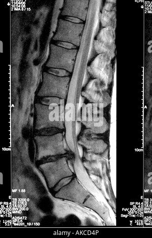 MRT-Untersuchung zeigt deutlich einen Bandscheibenvorfall drücken auf das Rückenmark und verursacht starken Schmerzen Stockfoto