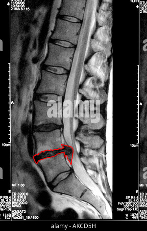 MRT-Untersuchung zeigt deutlich einen Bandscheibenvorfall drücken auf das Rückenmark mit den betroffenen Bereich in rot dargestellt Stockfoto