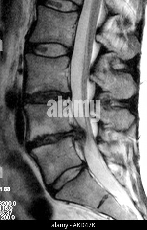 MRT-Untersuchung zeigt deutlich einen Bandscheibenvorfall drücken auf das Rückenmark und verursacht starken Schmerzen Stockfoto