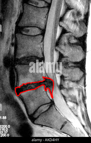 MRT-Untersuchung zeigt deutlich einen Bandscheibenvorfall drücken auf das Rückenmark mit den betroffenen Bereich in rot dargestellt Stockfoto