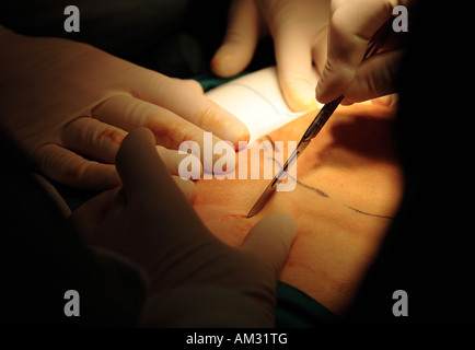 Chirurg macht ersten Schnitt in Patienten mit Skalpell im Operationssaal Stockfoto