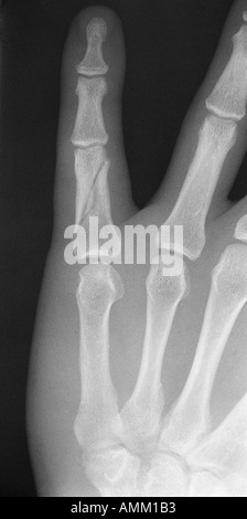 X-Ray schrägen Fraktur des proximalen Phalanx 5. finger Stockfoto