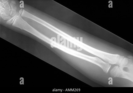 X-Ray Greenstick Bruch des Unterarms Stockfoto