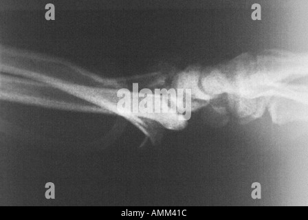 Seitliche X-Ray zerkleinerte distale Radius Fraktur Stockfoto