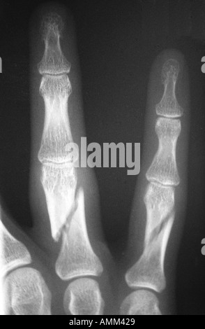 X-Ray proximalen Phalanx Frakturen Kind Stockfoto