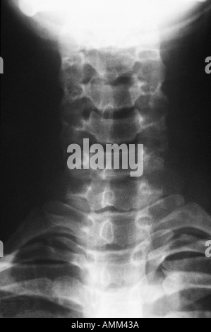 AP x Ray Halswirbelsäule Stockfoto