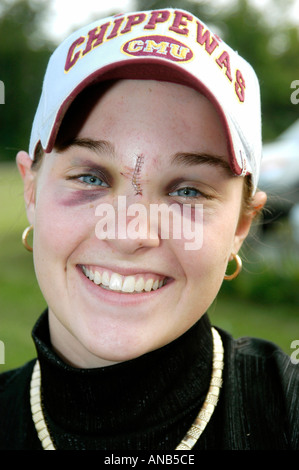 Verletzten weiblichen Teen mit schwarzen Augen und Stiche infolge von einem Pferd getreten Stockfoto