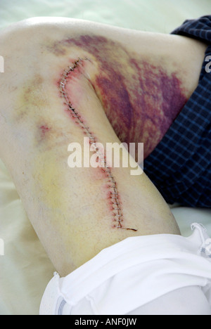 Grundnahrungsmittel Stiche & Prellungen männlichen Bein nach koronarer bypass Graft, Vene, mit anti-Blutgerinnsel chirurgischen Strumpf nach unten zu leihen Stockfoto