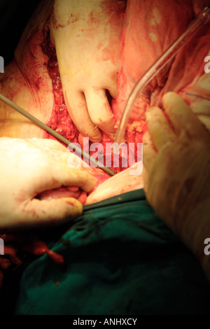 Chirurgen, die auf Patienten mit Darmkrebs Stockfoto