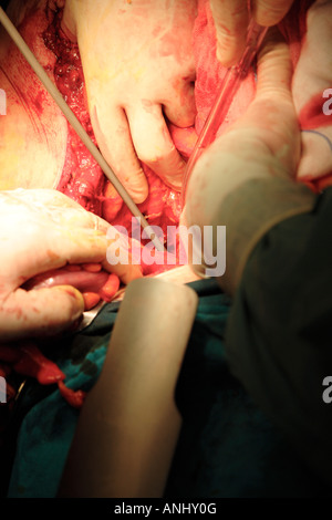 Chirurgen, die auf Patienten mit Darmkrebs Stockfoto