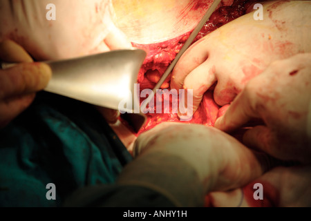 Chirurgen, die auf Patienten mit Darmkrebs Stockfoto