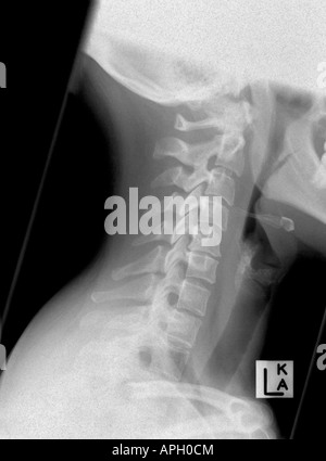 Seitliche Röntgenaufnahme einer zervikalen Wirbelsäule (Nacken), Krampf, aber kein Bruch, d. h. eine Verstauchung nur zeigen Stockfoto