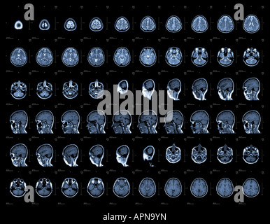 Gehirn und Kopf MRT oder CT-Bilder Stockfoto