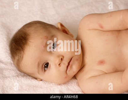 Baby Mädchen mit Windpocken im Gesicht und in der Brust, Virusviren, England, Englisch, Großbritannien, Großbritannien, Großbritannien, Großbritannien, Großbritannien Stockfoto