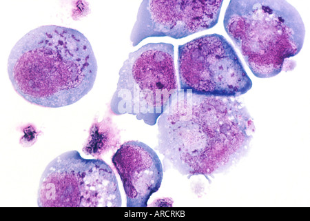 Histologischen Folie der menschlichen Herpes Virus-6 (HHV-6) vorher bekannt als HBLV Stockfoto