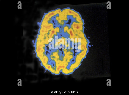 Ein normaler Positronen-Emissions-Tomographie (PET)-Scan des Gehirns. Stockfoto