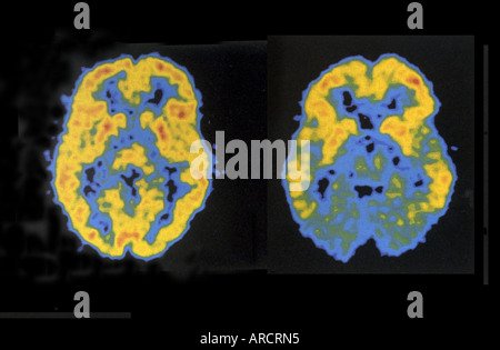 Ein paar PET-scans zeigen normale (links) und reduziert (rechts) Hirnaktivität. Stockfoto