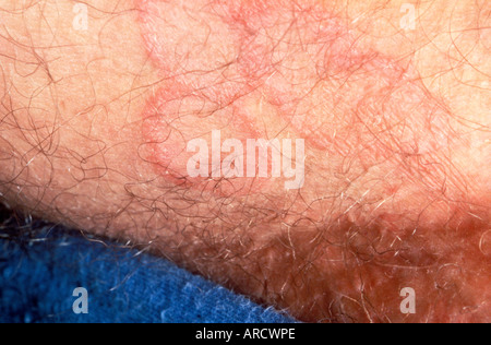 Scherpilzflechte ist eine Infektion der Haut, verursacht durch einen Pilz Stockfotografie - Alamy