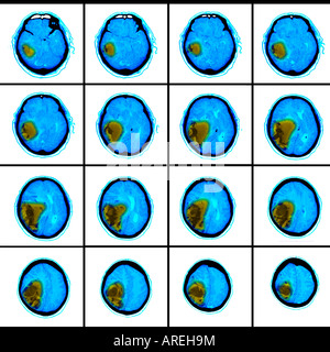 CT-Scan-Bilder zeigen einen hämorrhagischen Schlaganfall in ein 73 Jahre alter Mann Stockfoto