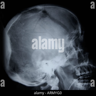 Crosstable seitliche Röntgenaufnahme des Schädels mit großen Bruch Stockfoto