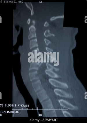 Seitliche Erwachsenen Hals gebrochen Stockfoto