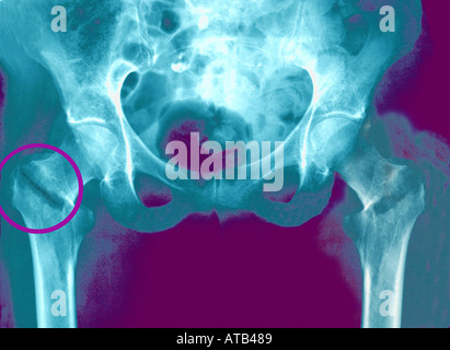 X-Ray bilaterale gebrochenen Hals des femur Stockfoto