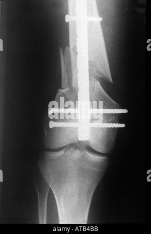 X-Ray gebrochenen Oberschenkelknochen mit Supracondylar Nagel Stockfoto