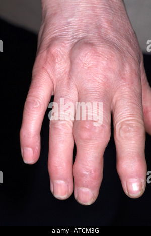 Arthritis auf lady's Hand zeigen, geschwollene Finger Stockfoto