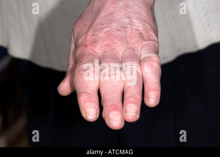 Arthritis auf lady's Hand zeigen, geschwollene Finger Stockfoto