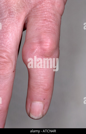 Arthritis auf lady's Hand zeigen, geschwollene Finger Stockfoto