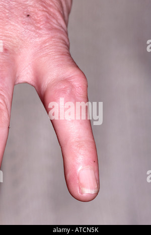 Arthritis auf lady's Hand zeigen, geschwollene Finger Stockfoto