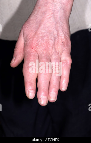 Arthritis auf lady's Hand zeigen, geschwollene Finger Stockfoto