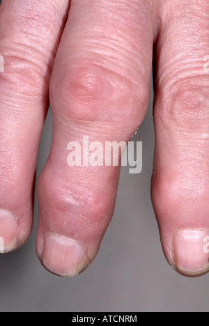 Arthritis auf lady's Hand zeigen, geschwollene Finger Stockfoto