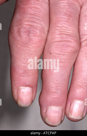 Arthritis auf lady's Hand zeigen, geschwollene Finger Stockfoto