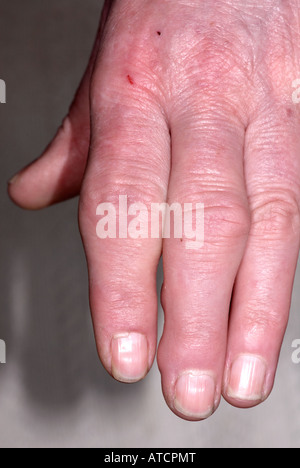 Arthritis auf lady's Hand zeigen, geschwollene Finger Stockfoto