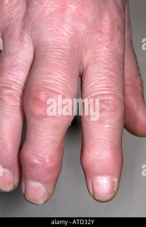 Arthritis auf lady's Hand zeigen, geschwollene Finger Stockfoto