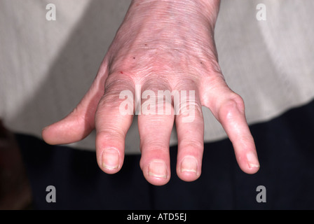 Arthritis auf lady's Hand zeigen, geschwollene Finger Stockfoto