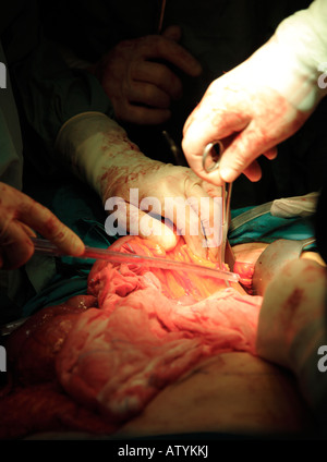 Chirurgen weggeschnitten werden Darmkrebs in Betrieb Stockfoto