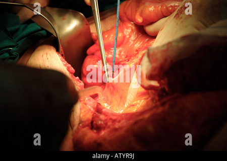 Chirurg mit elektrischen Skalpell durchtrennen Peritoneum während des Betriebs, Darmkrebs zu entfernen Stockfoto