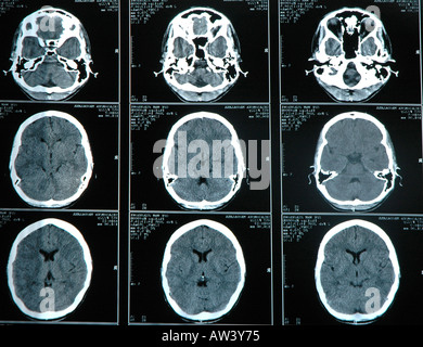 Computer-Tomographie CT Fotografie des menschlichen Gehirns Stockfoto