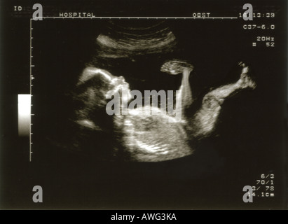 20 Woche eine vorgeburtliche Vollprofil Schwangerschaft Ultraschalluntersuchung der gesunden Midterm Fötus Baby in Utero Gebärmutter entwickeln, wachsen Stockfoto