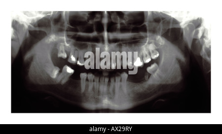 Orthopantomogram OPG auch bekannt als Orthopantomogramm oder panorex Stockfoto