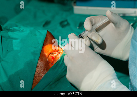 Katarakt-Operation durchgeführt in einem OP-Saal in Pietermaritzburg, Südafrika, Afrika Stockfoto